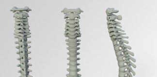 Jak się leczy wypadanie pochwy?